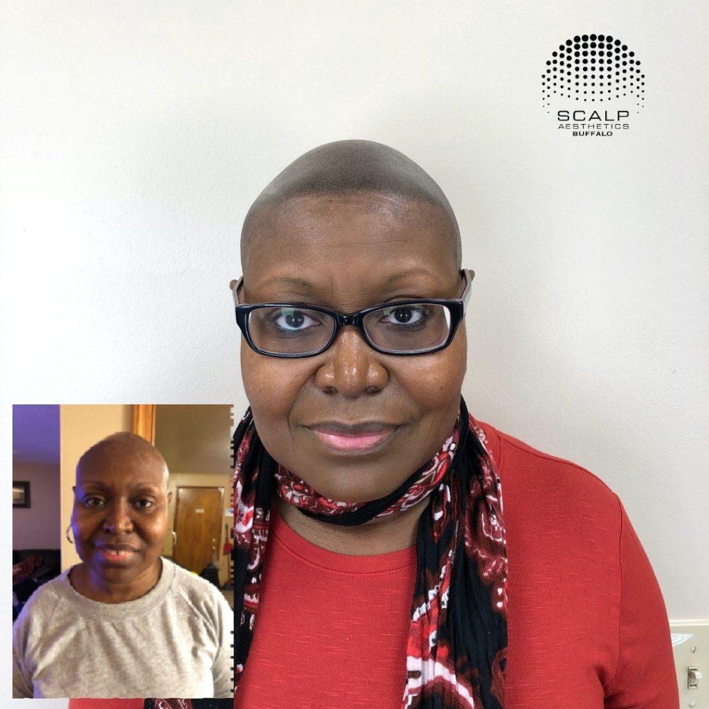 Scalp micropigmentation for alopecia before and after results