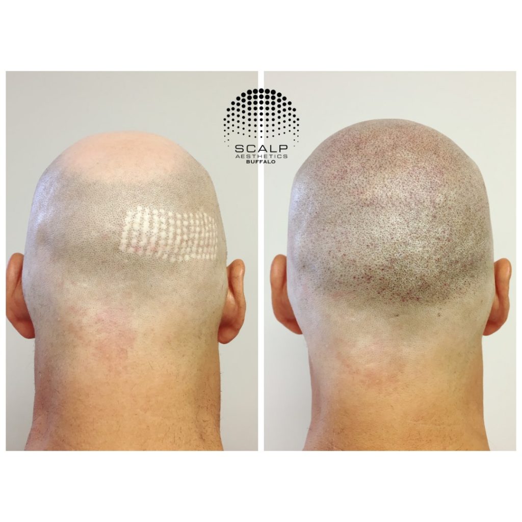 Before and after SMP for scarring coverage